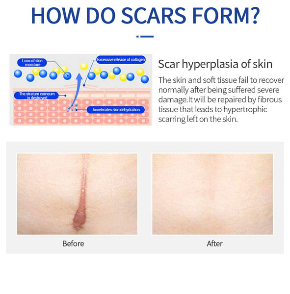 Scar Removal Cream Gel